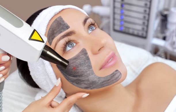 Get Flawless And Glowing Skin With High Quality Carbon Laser Peel